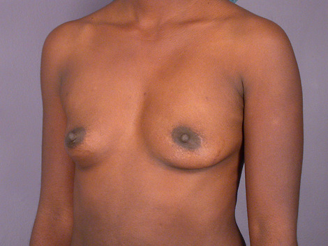 Breast Augmentation before and after photo