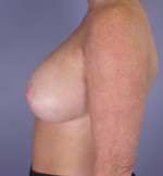 Breast Augmentation Before and after photo