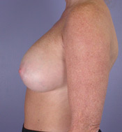 Breast Augmentation before and after photo