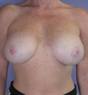 Breast Augmentation before and after photo