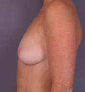 Breast Augmentation before and after photo