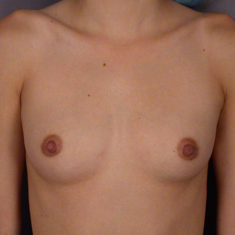 Breast Augmentation before and after photo