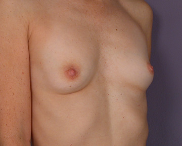 Breast Augmentation before and after photo