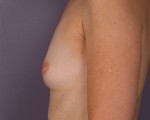 Breast Augmentation Before and after photo