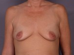 Breast Augmentation