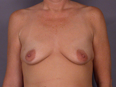 Breast Augmentation before and after photo