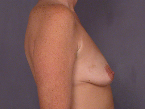 Breast Augmentation before and after photo