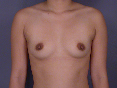 Breast Augmentation before and after photo