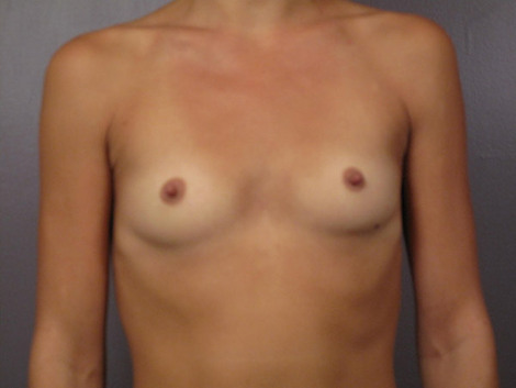 Breast Augmentation before and after photo