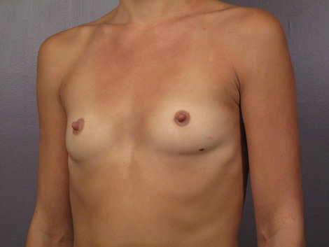 Breast Augmentation before and after photo