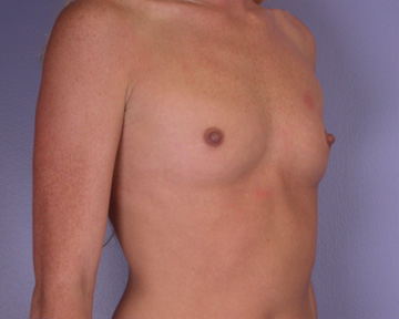 Breast Augmentation before and after photo