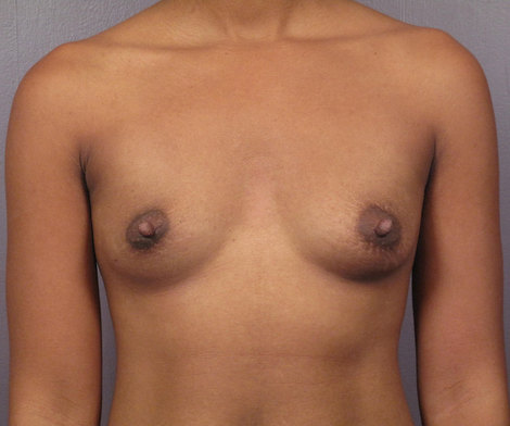 Breast Augmentation before and after photo