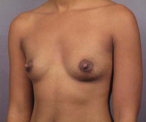 Breast Augmentation before and after photo