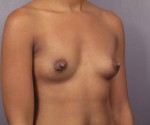 Breast Augmentation Before and after photo