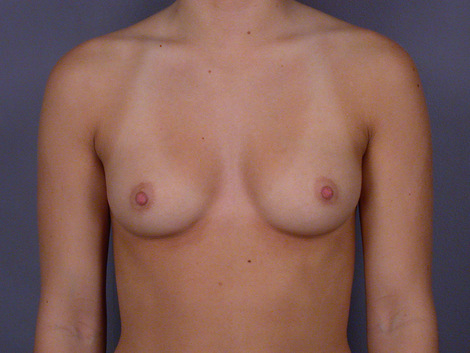 Breast Augmentation before and after photo