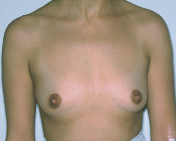 Breast Augmentation before and after photo