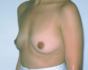 Breast Augmentation before and after photo