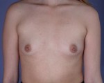 Breast Augmentation Before and after photo