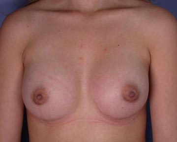 Breast Augmentation before and after photo