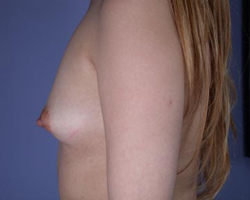 Breast Augmentation before and after photo