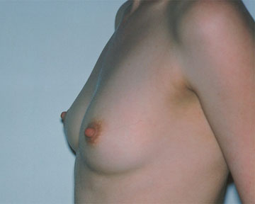 Breast Augmentation before and after photo