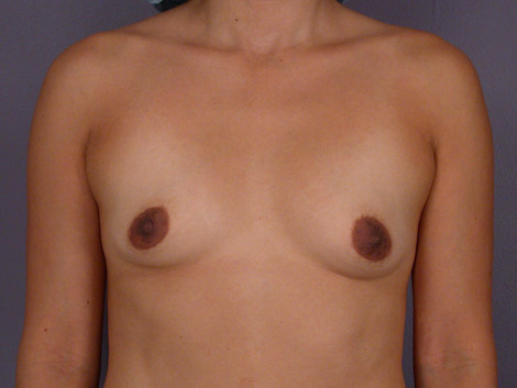 Breast Augmentation before and after photo