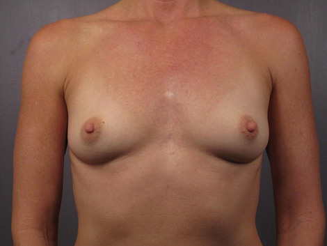 Breast Augmentation before and after photo