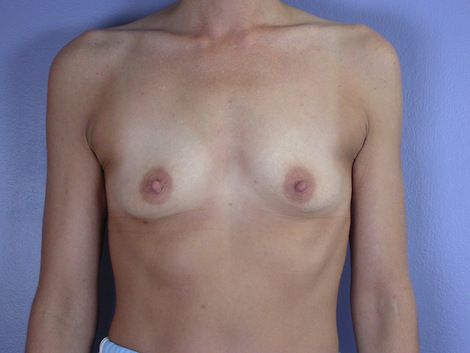 Breast Augmentation before and after photo