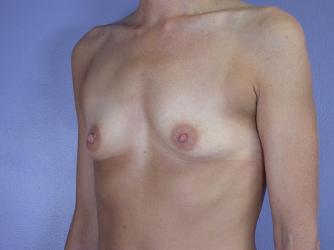 Breast Augmentation before and after photo