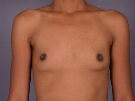 Breast Augmentation before and after photo