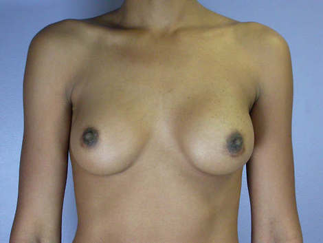 Breast Augmentation before and after photo