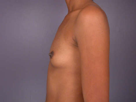 Breast Augmentation before and after photo