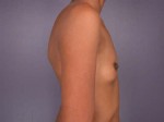 Breast Augmentation Before and after photo