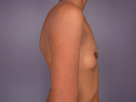 Breast Augmentation before and after photo