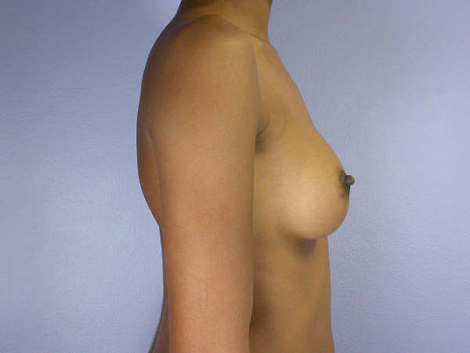 Breast Augmentation before and after photo