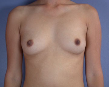 Breast Augmentation before and after photo