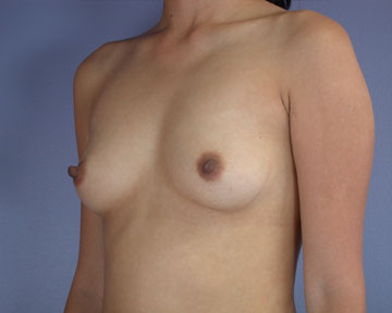 Breast Augmentation before and after photo