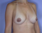 Breast Augmentation Before and after photo