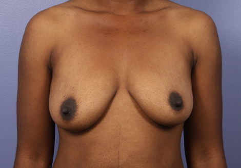 Breast Augmentation before and after photo