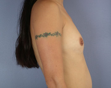 Breast Augmentation before and after photo