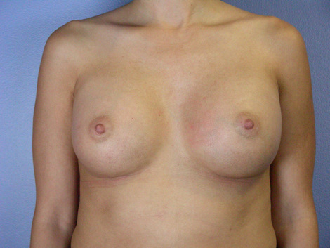 Breast Augmentation before and after photo