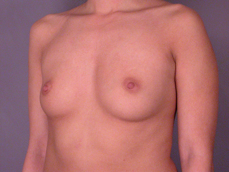 Breast Augmentation before and after photo