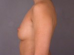 Breast Augmentation Before and after photo