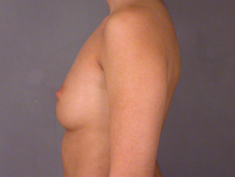 Breast Augmentation before and after photo