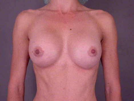 Breast Augmentation before and after photo