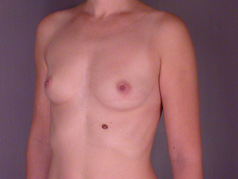 Breast Augmentation before and after photo