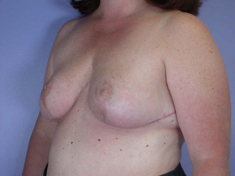 Breast Reduction (for Women) before and after photo