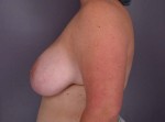 Breast Reduction (for Women) Before and after photo