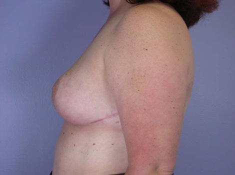 Breast Reduction (for Women) before and after photo