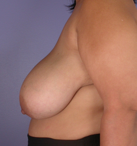 Breast Reduction (for Women) before and after photo